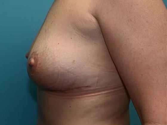Breast Lift Before & After