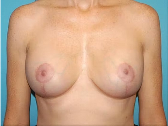 Breast Lift Before & After