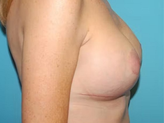 Breast Lift Before & After