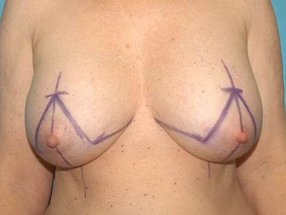 Breast Lift Before & After
