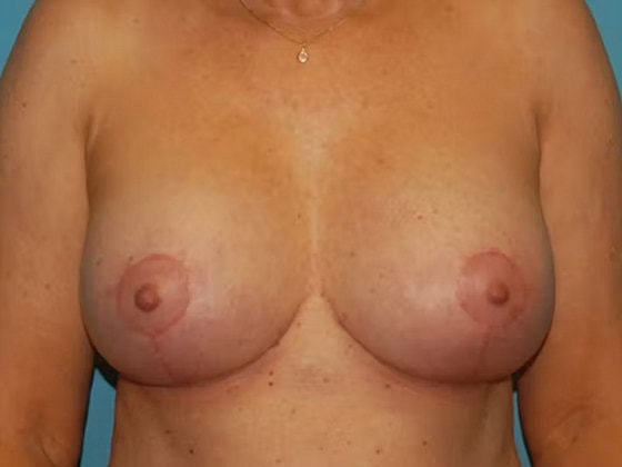 Breast Lift Before & After