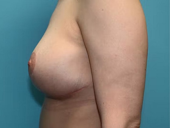 Breast Lift Before & After