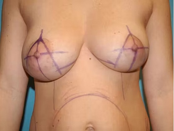 Breast Lift Before & After