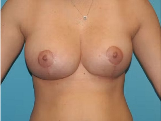 Breast Lift Before & After