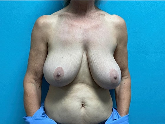 Breast Lift Before & After
