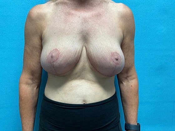 Breast Lift Before & After
