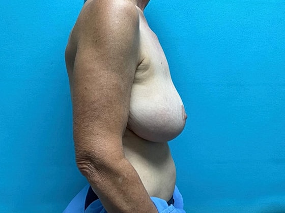 Breast Lift Before & After