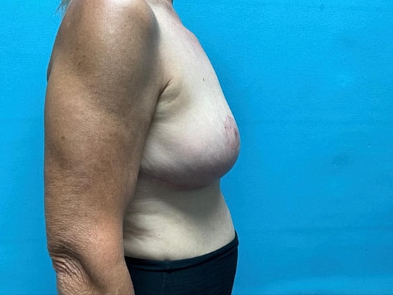 Breast Lift Before & After