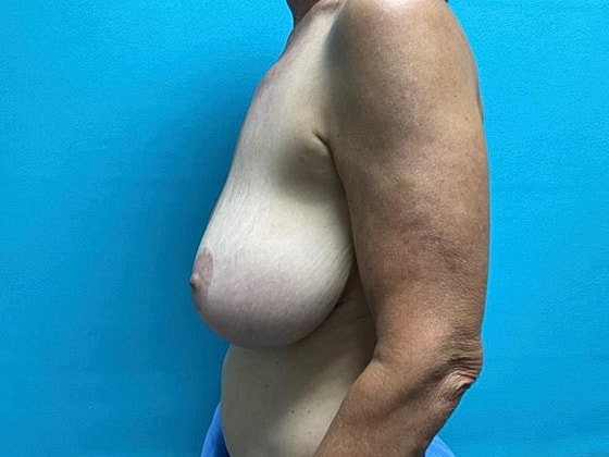 Breast Lift Before & After