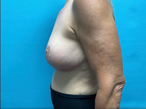 Breast Lift Before & After
