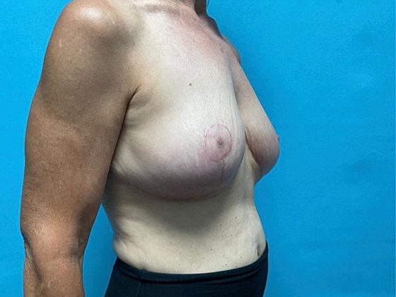 Breast Lift Before & After