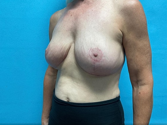 Breast Lift Before & After