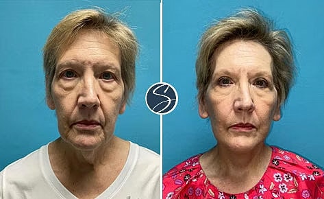 patient before and after
