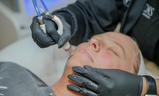 Staff showing patient microneedling tool