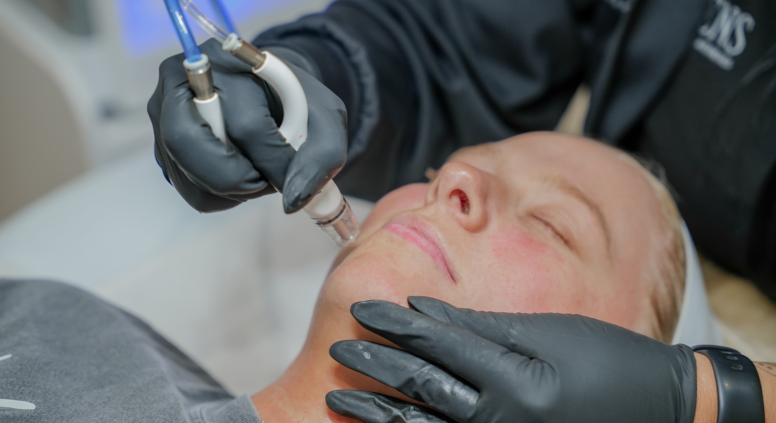 Facial treatment with microneedling technique in progress.